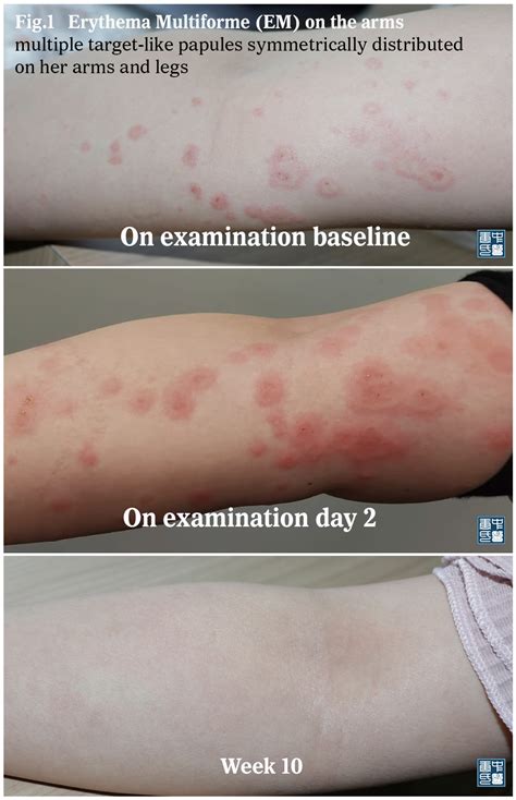 scratch test urticaria|erythema vs urticaria.